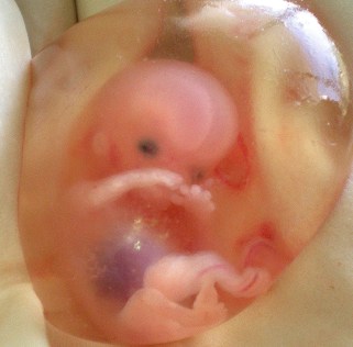 ABORTION - fetus